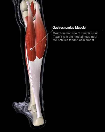 Common site of gastrocnemius strain tear