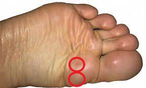Photo of the sole of a foot with two red circles showing the location of the sesamoid bones. 