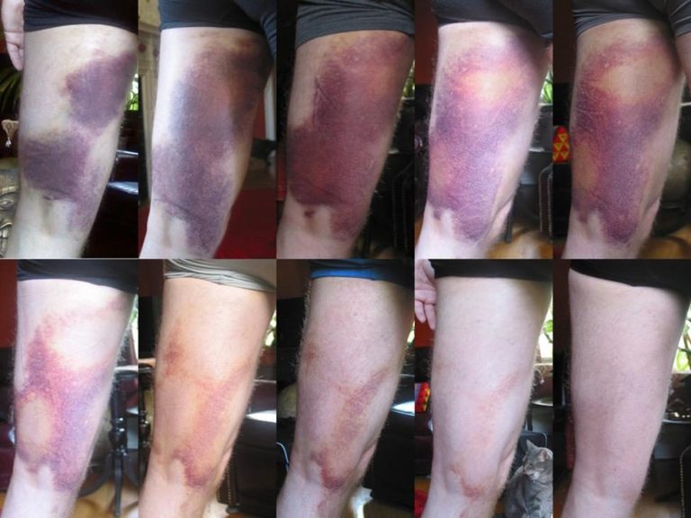 Remedial Massage for Muscle Bruises, Contusions, and Hematomas