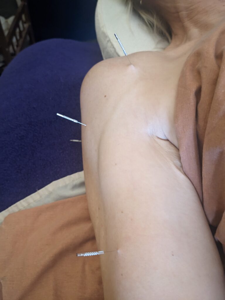 Photo of a person's arm with four myofascial dry needles inserted into the bicep and deltoid muscles.